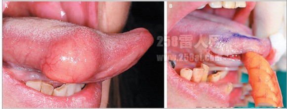 舌头上长了肿瘤 看起来很渗人