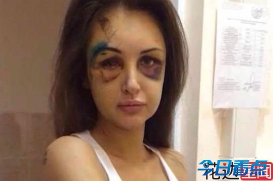 俄模特与富翁男友分手遭暴打 脸毁成“僵尸”