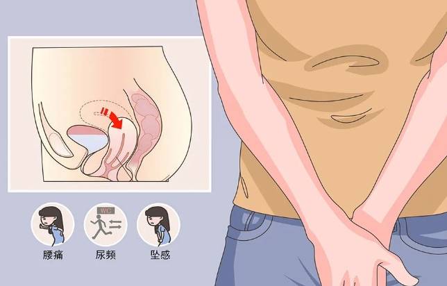 子宫下垂有什么危害(附如何预防和治疗)