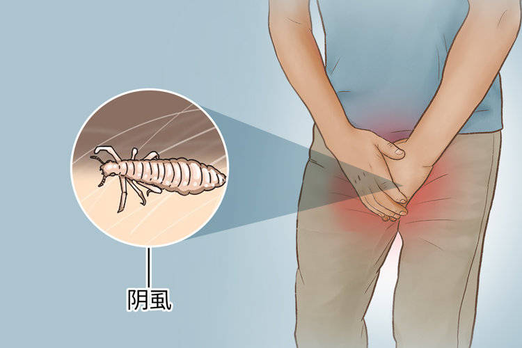 阴虱病会有什么症状如何治疗(阴虱的三个传染途径)