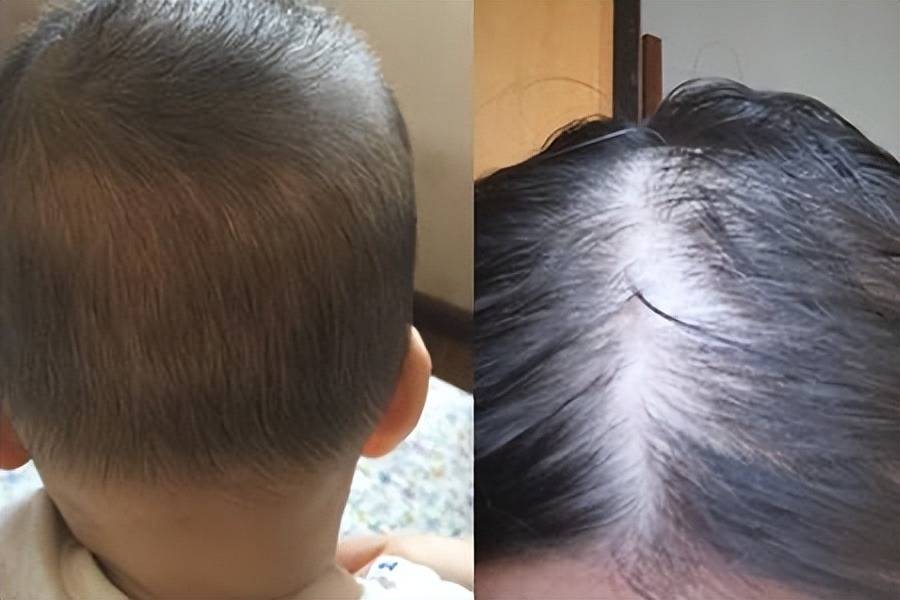 小孩子头发稀疏怎么回事(经常剃光头对头发好吗)
