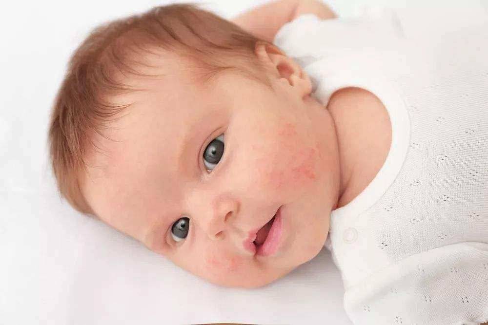 新生儿湿疹是什么引起的(新生儿脸部湿疹怎么护理)