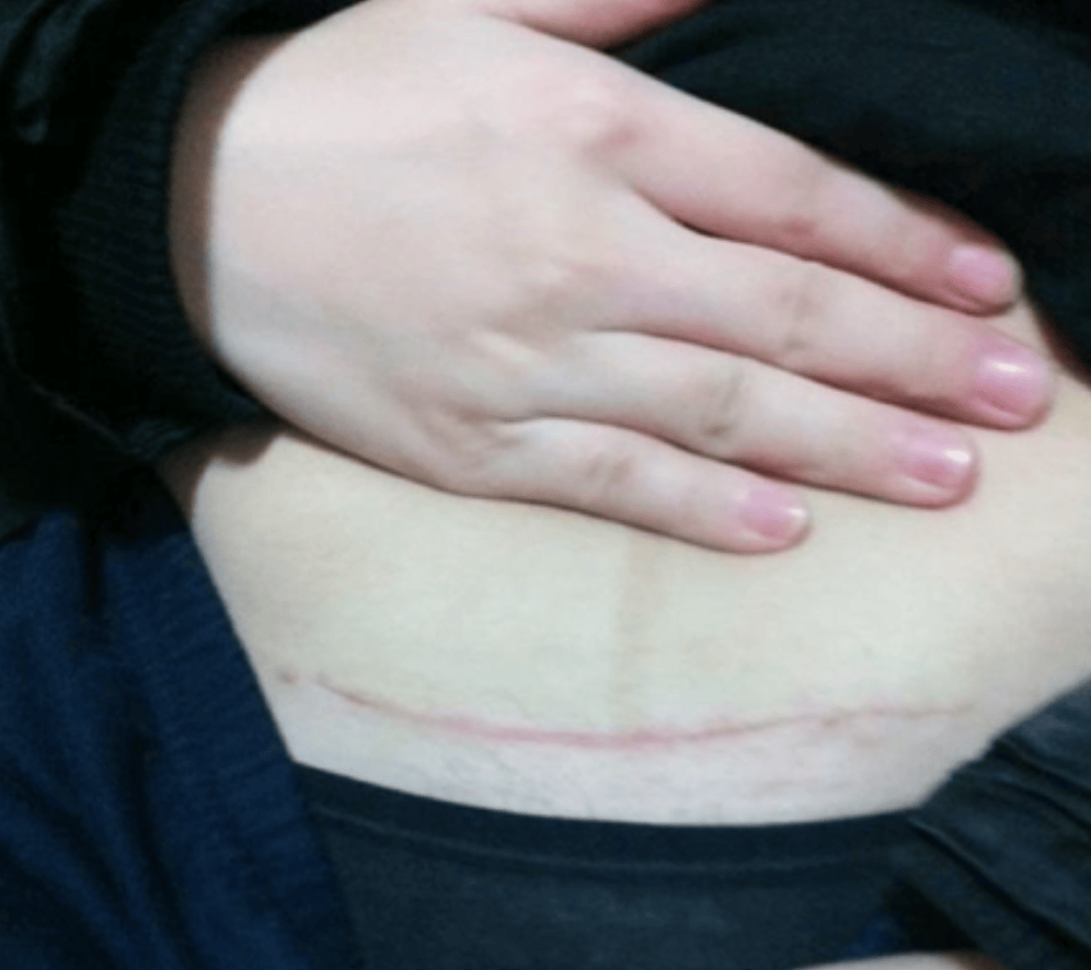 顺产和剖腹产有什么区别？一般有三点,身为女性要了解