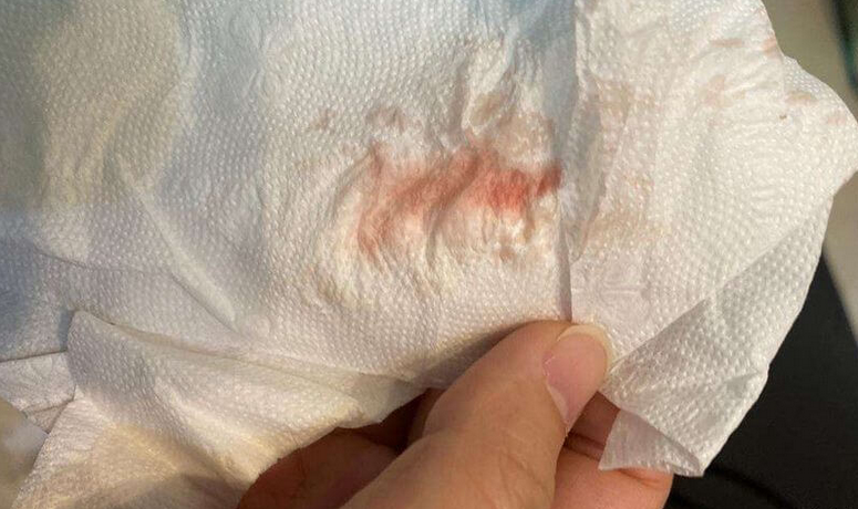 查妇科tct会检查哪些症状(tct检查后一直不舒服怎么办)