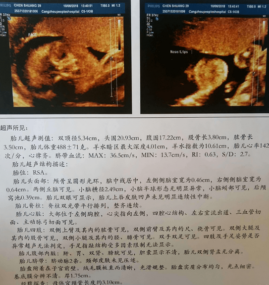 小排畸检查需要注意什么(做小排畸怎么才能让宝宝配合)
