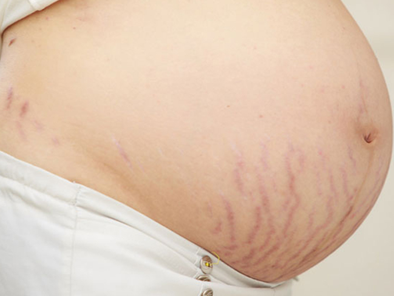 妊娠线怎么看是生男孩还是女孩？妊娠线歪的是否一定是女孩