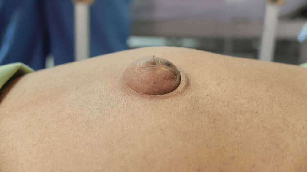 宝宝腹股沟和肚脐出现鼓包,可能是疝气