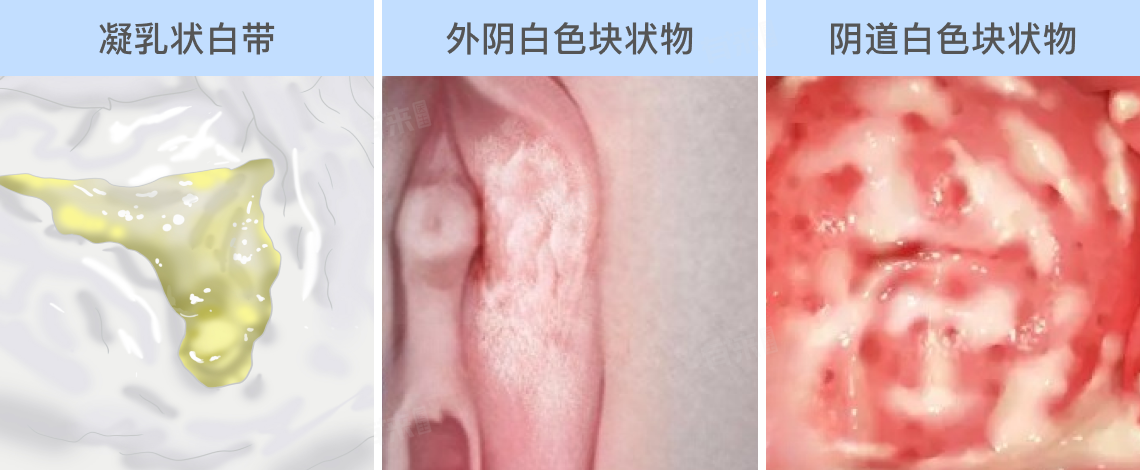 霉菌性阴道炎什么样？