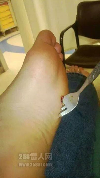 人的脚被叉子叉破了