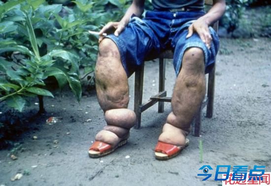多米尼加少女患血汗症 流汗流泪都是血