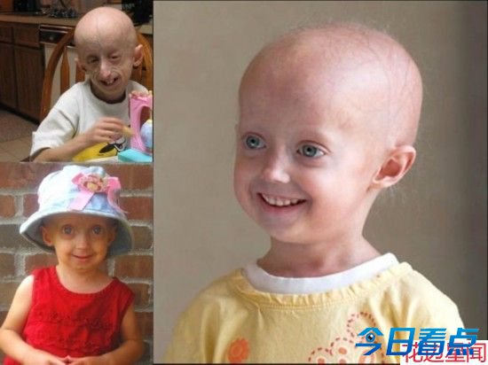 多米尼加少女患血汗症 流汗流泪都是血