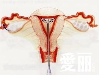 剩女靠人工授精当妈 自孕自产男人靠边