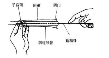 剩女靠人工授精当妈 自孕自产男人靠边