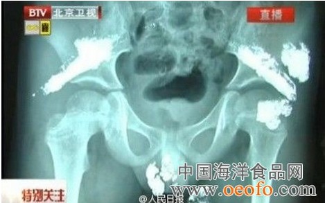 5岁男童被灌大量汞：男童揭汞中毒暗含惊天秘密