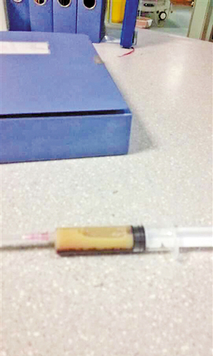 球迷抽血竟然抽出半管油