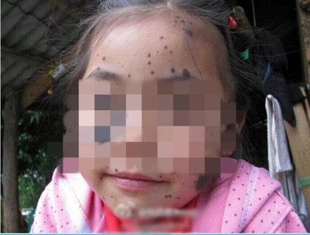泸州罕见兽皮女孩近况
