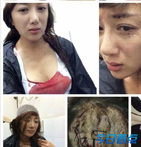李依晓还原被咬经过 叶璇经纪人怒斥炒作